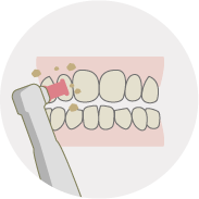 歯のクリーニング 歯垢・歯石の除去