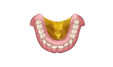 金属床義歯