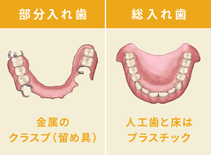 部分入れ歯：金属のクラスプ（留め具）、総入れ歯：人工歯と床はプラスチック