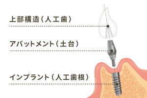 インプラントの構造