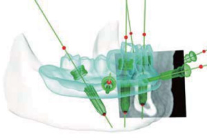 インプラント手術用3Dシミュレーションシステム