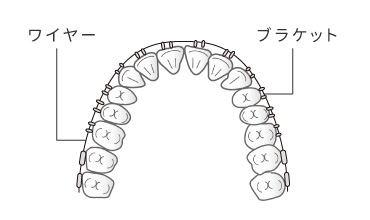 マルチブラケット（表側矯正）