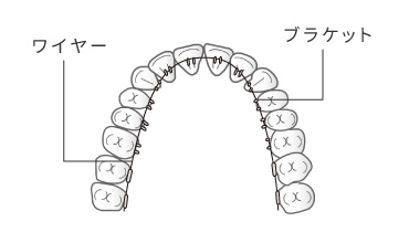 リンガルブラケット（舌側矯正）