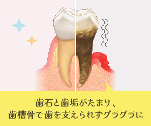 歯石と歯垢がたまり、歯槽骨で歯を支えられずグラグラに