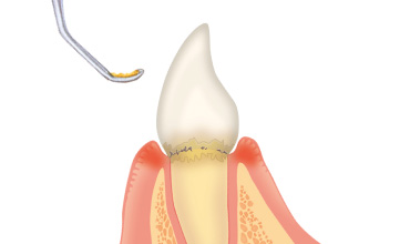 スケーリング（歯石取り）