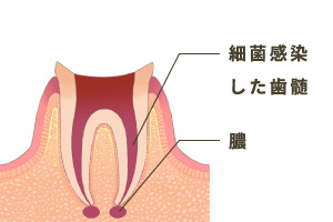 根管の清掃・消毒