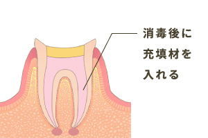 充填剤で密封