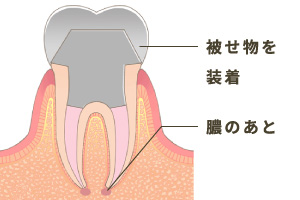 被せ物の装着